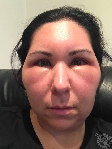 Angioedema is a type of allergic reaction that causes swelling that goes down deep within the skin. . Embalming swollen face